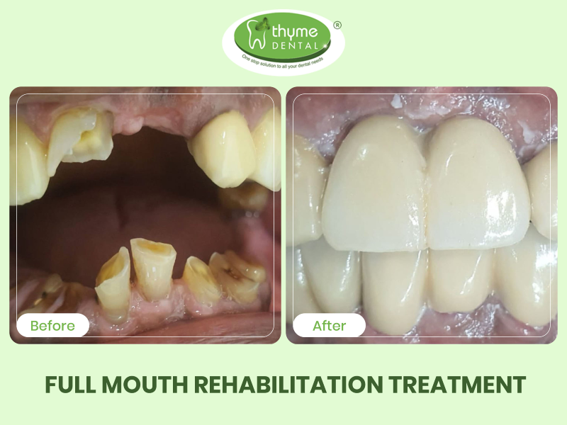 Dental Treatment - Thyme Dental