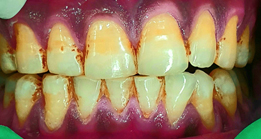 Before Dental Treatment