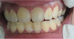 Before image - Thyme Dental
