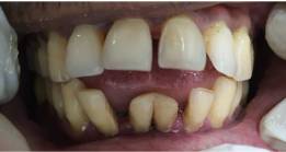 Before Treatment - Thyme Dental multi-speciality dental clinic