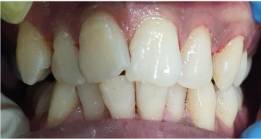 After Dental Treatment - Thyme Dental