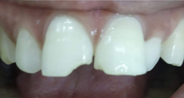 Before Thyme dental treatment