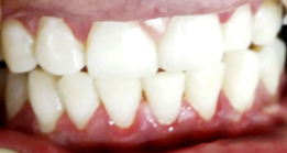 Dental cleaning Thyme dental