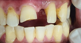 Before image Tooth problem