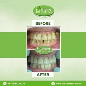 Smile Makeover