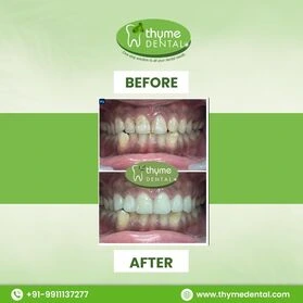 Smile Makeover