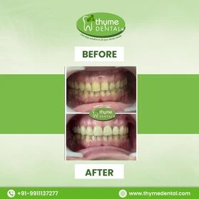 Smile Makeover