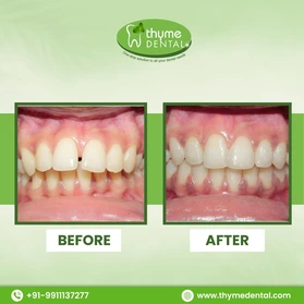 Smile Makeover