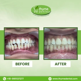 Smile Makeover