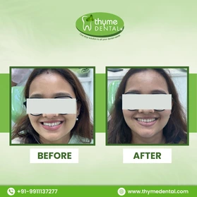 Smile Makeover
