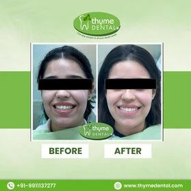 Smile Makeover