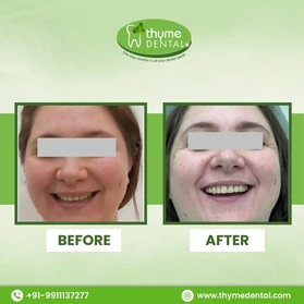 Smile Makeover