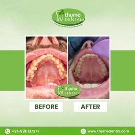Smile Makeover
