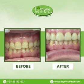 Smile Makeover