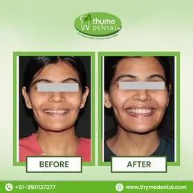 Smile Makeover