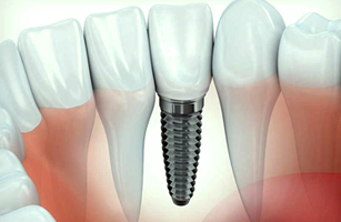 Dental implant Gurgaon