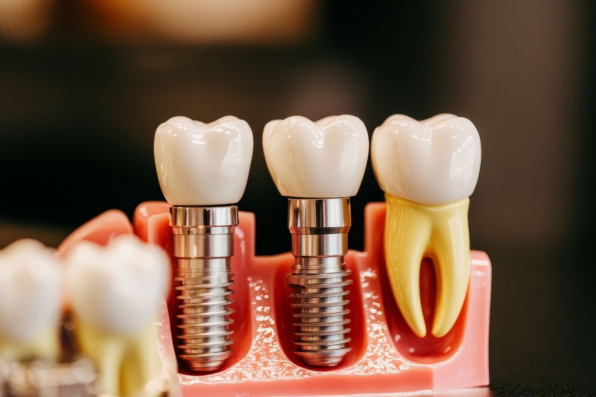 Dental Implants