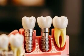 Dental Implants