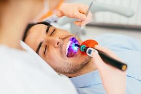 Tooth Coloured Fillings